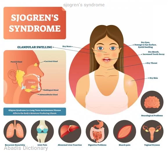 sjogren’s syndrome